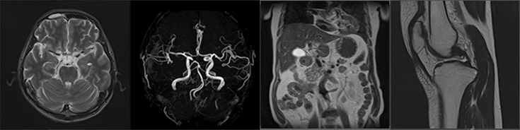 MRI（東芝製：Vantage Titan 1.5テスラ）